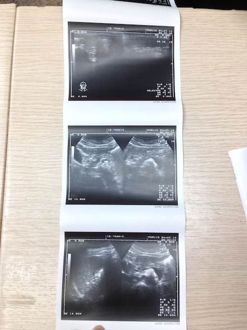 超音波 Ultrasound5